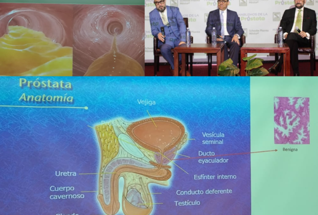 Consulta síntomas de dolor en próstata o Síntomas del Tracto Urinario Inferior